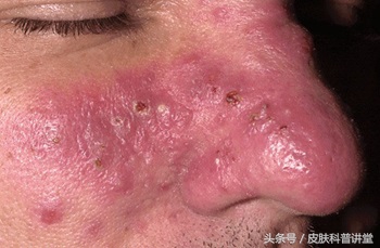 酒渣鼻玫瑰座疮用什么药膏,酒渣鼻玫瑰痤疮能自愈吗