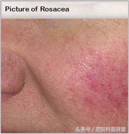 酒渣鼻玫瑰座疮用什么药膏,酒渣鼻玫瑰痤疮能自愈吗