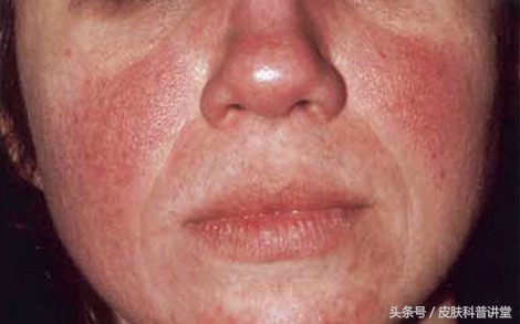 酒渣鼻玫瑰座疮用什么药膏,酒渣鼻玫瑰痤疮能自愈吗