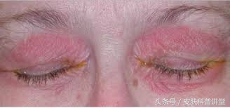 酒渣鼻玫瑰座疮用什么药膏,酒渣鼻玫瑰痤疮能自愈吗