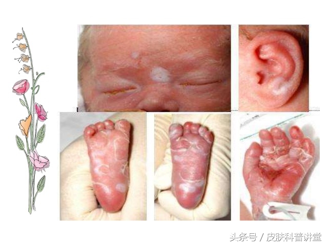 胎传梅毒诊断标准,胎传梅毒能彻底治愈吗