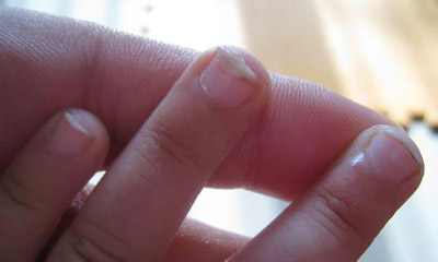 宝宝灰指甲怎么办？美莉妈咪来教你天然抗菌