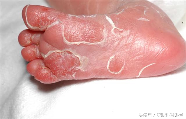 胎传梅毒诊断标准,胎传梅毒能彻底治愈吗