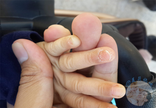 宝宝灰指甲怎么办？美莉妈咪来教你天然抗菌