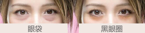 黑眼圈或眼袋很重?20几岁的年纪怎么办?