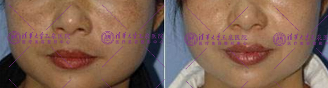 不复发黄褐斑怎么治疗,褐斑用什么治最好