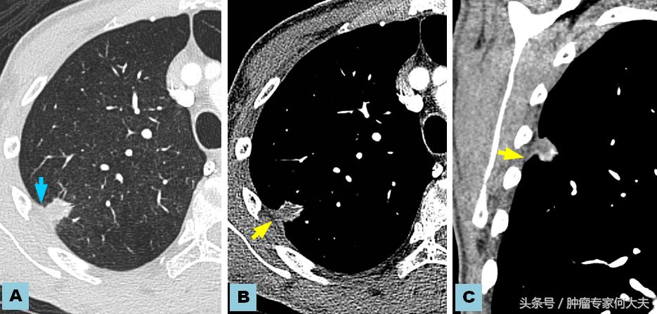 肺癌晚期临死30天症状,肺癌小细胞晚期快死的征兆