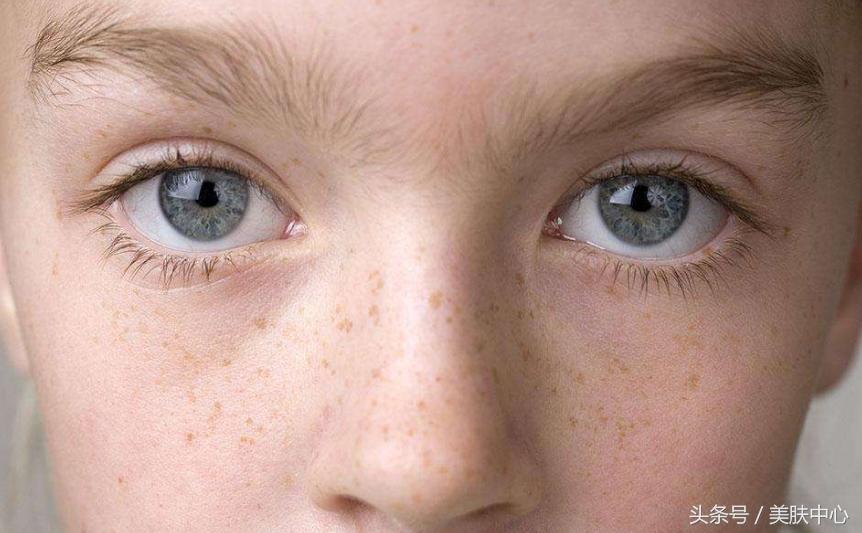 不用花钱怎么才能去掉脸上的斑点,不用花钱去掉斑