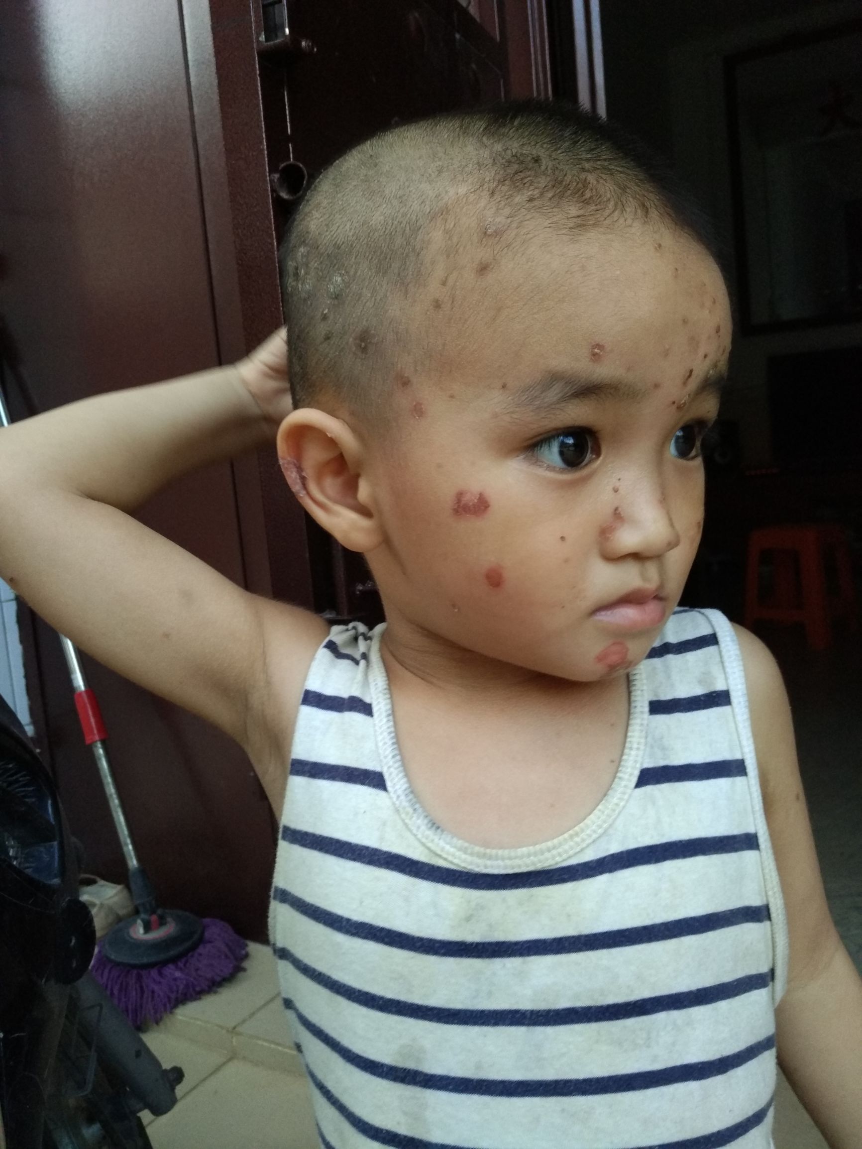 孩子在幼儿园被传染上虱子怎么办,小孩被传染疮了怎么办