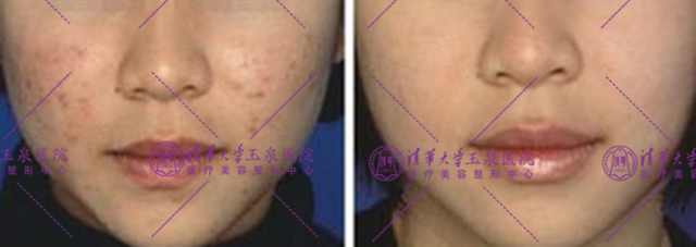 不复发黄褐斑怎么治疗,褐斑用什么治最好