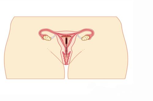 节育环戴时间长了会长进肉里去吗,节育环如果长到肉里会有什么反应