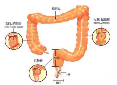 恶性肿瘤出血原因,哪些病是出血疾病