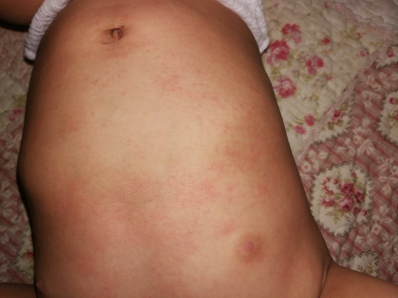 新手妈妈遇到幼儿急疹,幼儿急疹如何护理宝妈必看