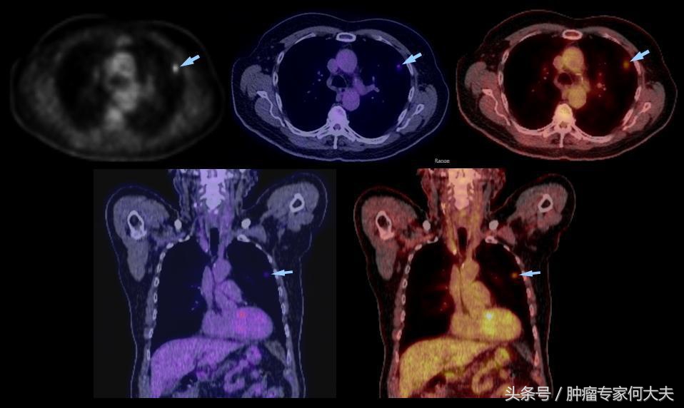 肺癌晚期临死30天症状,肺癌小细胞晚期快死的征兆