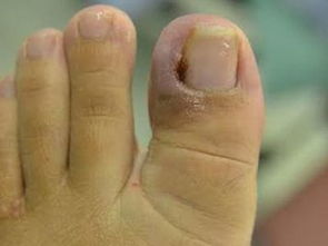 甲沟炎怎么治疗能彻底除根,脚趾甲沟炎怎么治疗最有效