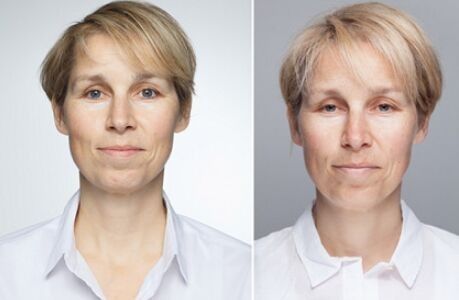 俄罗斯专家注射细菌抗衰老,抗衰老的细菌