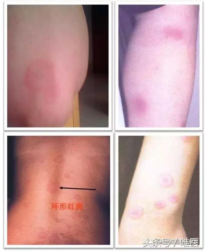 受寒骨关节炎,关节疼类风湿关节炎医学知识科普