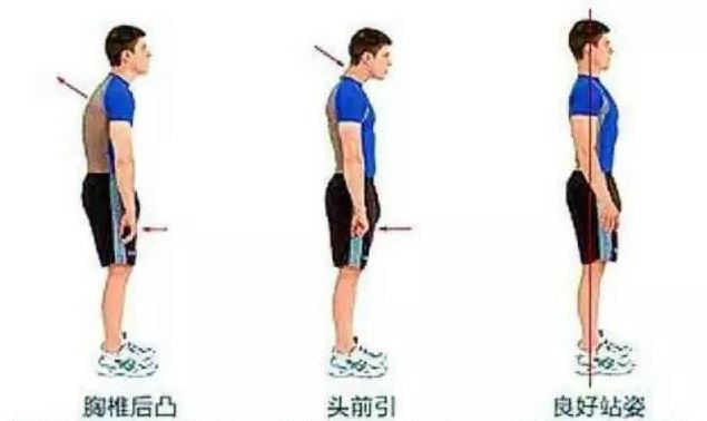 圆肩、驼背、探颈——“上交叉综合症”的纠正方法
