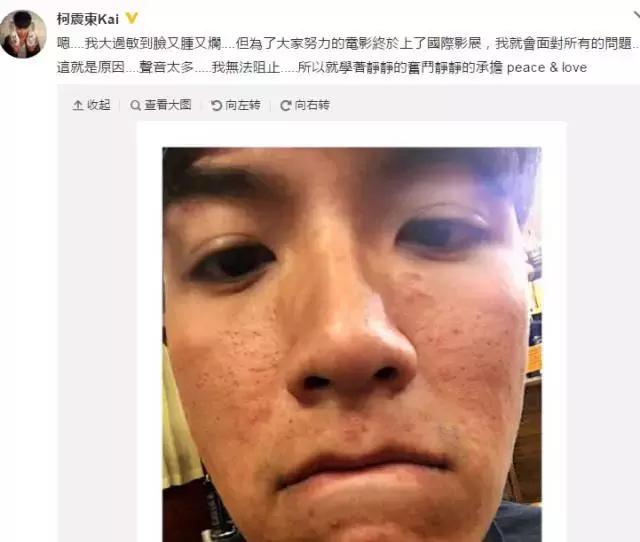 换季肌肤敏感怎么解决,秋季脸部敏感泛红是怎么了