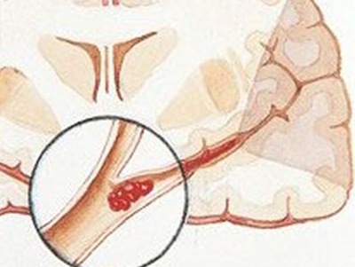 腔隙性脑梗塞能做血液净化吗,预防腔隙性脑梗死