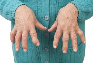 晨起手指麻木是什么原因和征兆,晨起手肿胀要警惕四种病