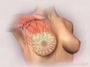 副乳腋下淋巴结堵塞,腋下淋巴结肿大活检危害