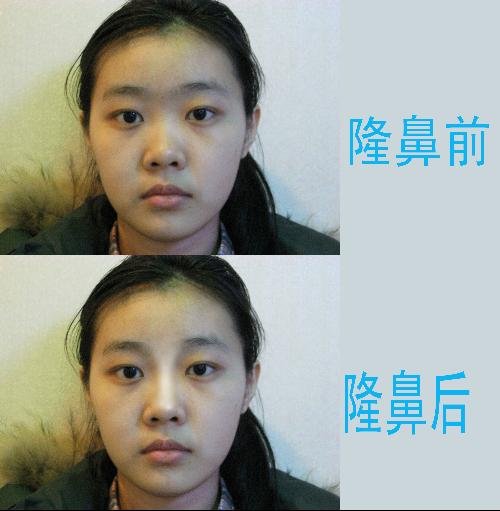 详述隆鼻硅胶和膨体优缺点,隆鼻硅胶优缺点