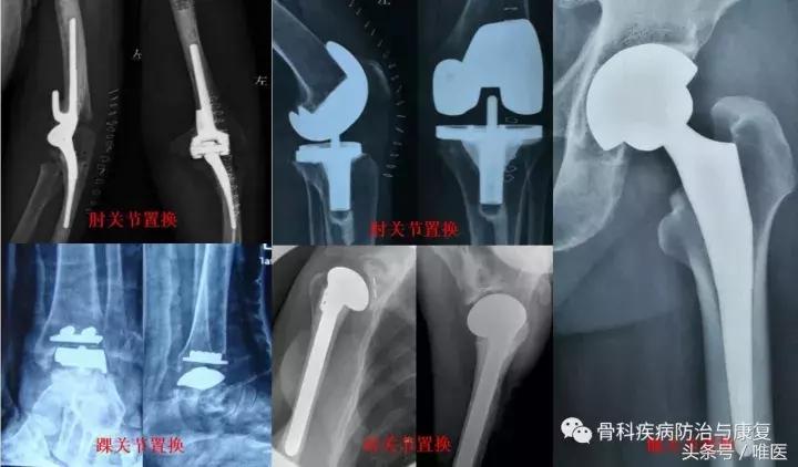 受寒骨关节炎,关节疼类风湿关节炎医学知识科普