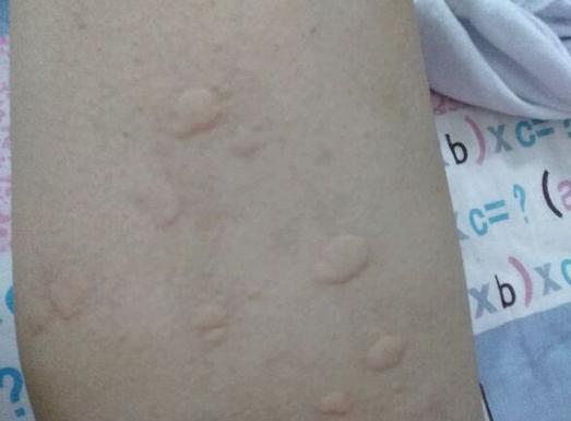 一个彻底根除荨麻疹的土方法,超详细的荨麻疹治疗方案