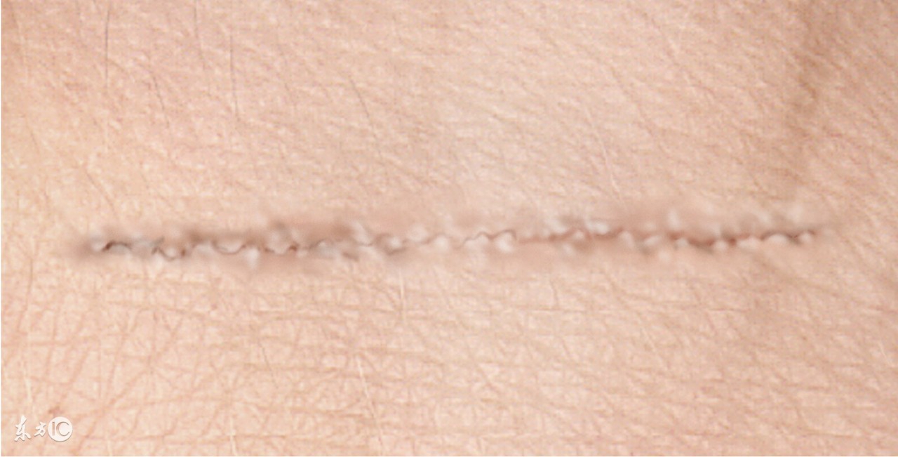 激光祛黑色素疤痕真的有效吗,激光祛烫伤黑色素疤痕