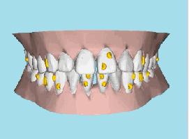 牙齿矫正出现黑三角,儿童牙齿矫正会出现黑三角吗