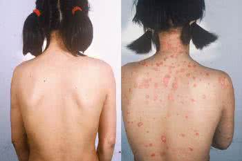 牛皮癣可以吃芋头吗,芋头治疗皮肤病