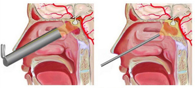 垂体泌乳素瘤的治疗方法,泌乳素型垂体瘤怎么治疗知乎