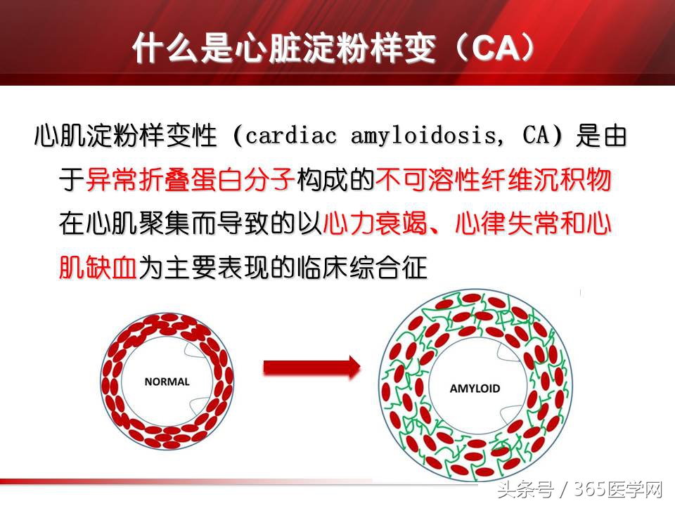 心力衰竭心房颤动,心衰时心肌酶的变化
