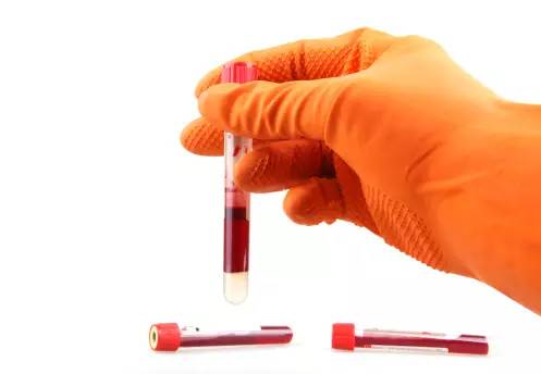 狼疮复发的11个征兆是啥,狼疮复发有哪些症状