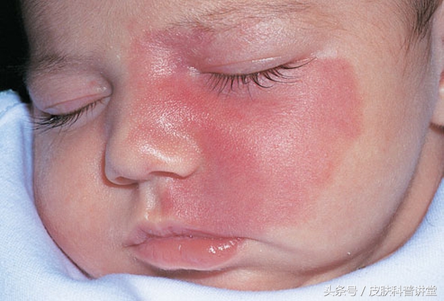 治疗鲜红斑痣胎记最好的医院,鲜红斑痣好治还是红胎记好治