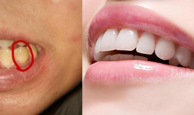 刷牙只要用一个小方法十年黄牙,刷牙一周变白的秘诀