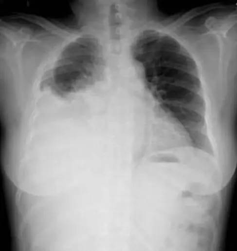 狼疮复发的11个征兆是啥,狼疮复发有哪些症状