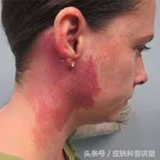 治疗鲜红斑痣胎记最好的医院,鲜红斑痣好治还是红胎记好治
