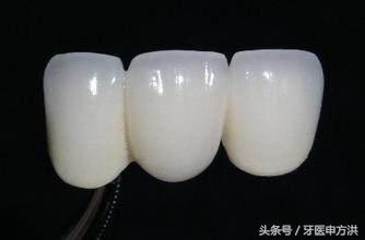 烤瓷牙边缘变黑了怎么修复,烤瓷牙真牙变黑了怎么处理