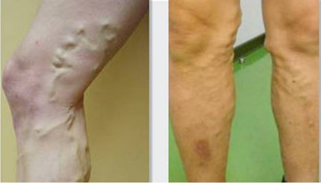 下肢静脉曲张的症状及治疗方法,下肢静脉轻度曲张穿几级弹力袜