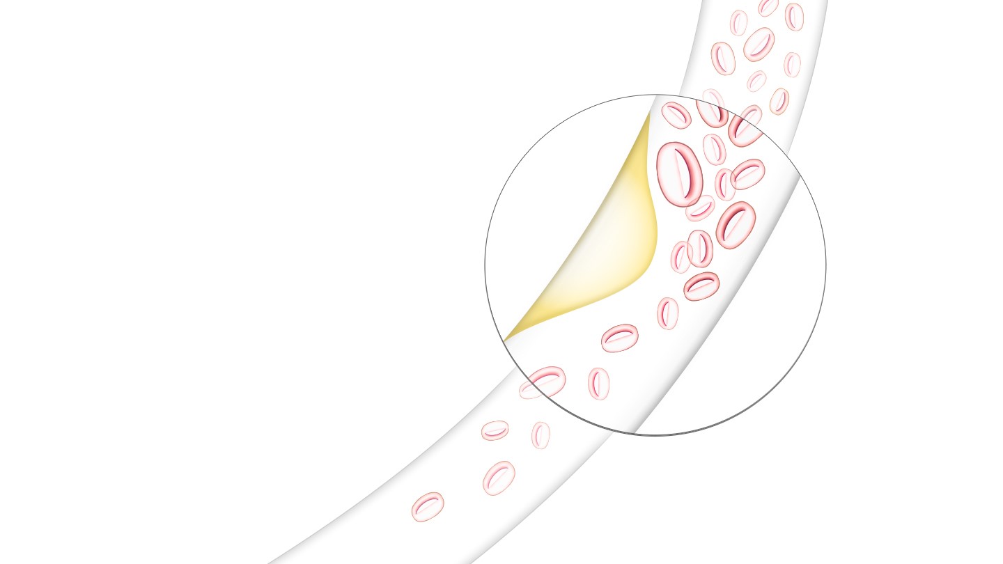 高胆固醇吃什么药,高胆固醇的食物有哪些