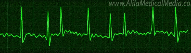 做房颤射频消融手术前的注意事项,房颤射频消融术后如何康复