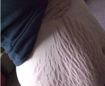 产后橄榄油可以去除妊娠纹吗,产后祛除妊娠纹最有效的方法