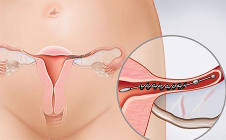 怀孕初期宫外孕的症状,宫外孕多少天会有症状反应