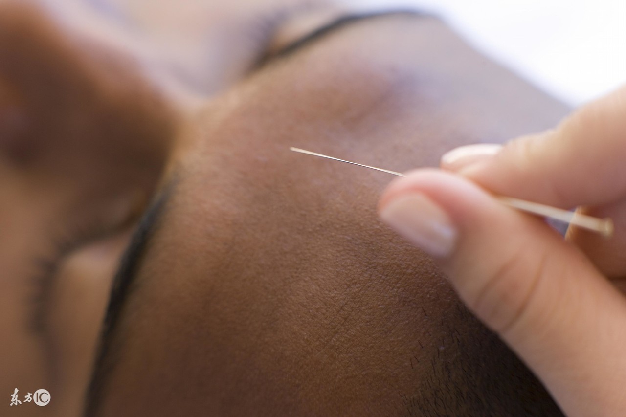 浮针治头痛视频,浮针治疗丛集性头痛