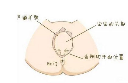 生小孩时你被“侧切”了吗？