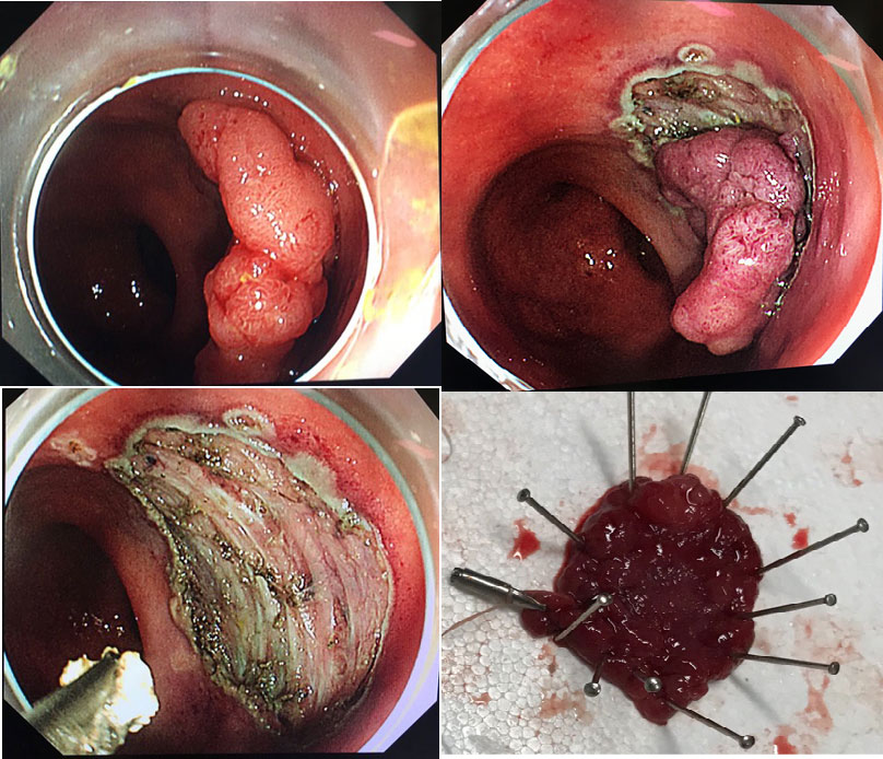 内镜食管黏膜下剥离术,内镜食管粘膜下剥离术