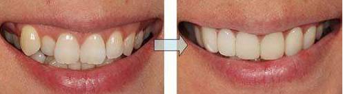 网上买透明牙套矫正牙齿靠谱吗,小孩矫正牙齿用哪种牙套比较好