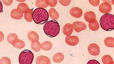 半导体激光治疗高血压,弱激光治疗仪对三高真有疗效吗